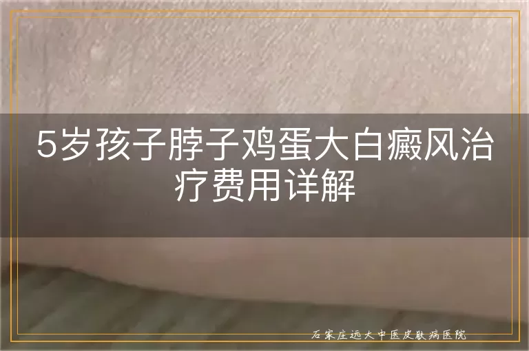 5岁孩子脖子鸡蛋大白癜风治疗费用详解