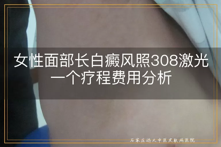 女性面部长白癜风照308激光一个疗程费用分析