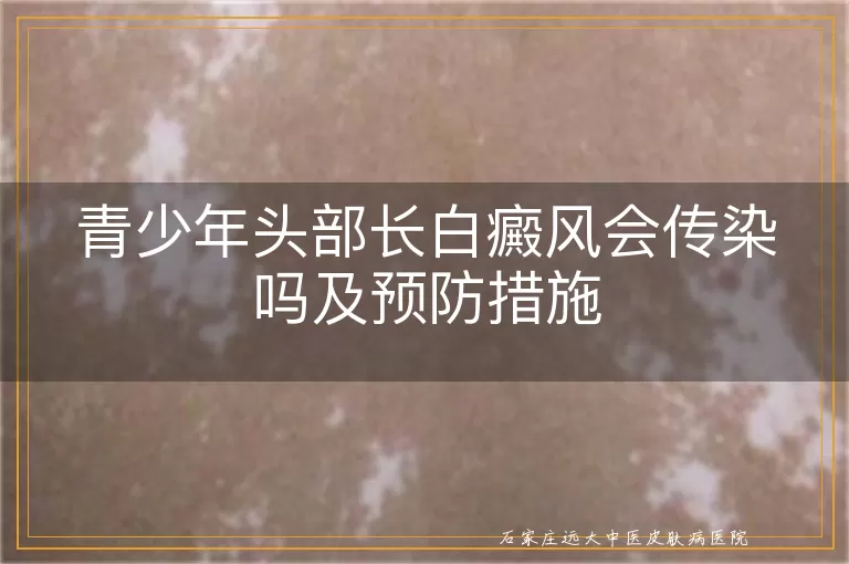 青少年头部长白癜风会传染吗及预防措施