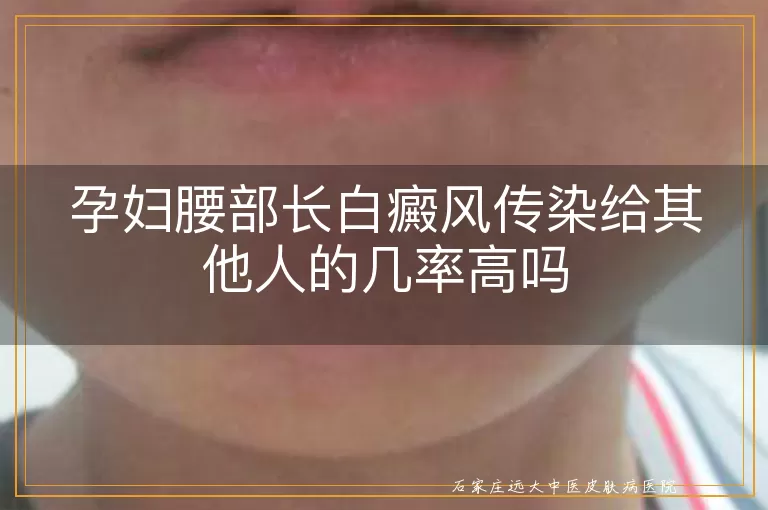 孕妇腰部长白癜风传染给其他人的几率高吗