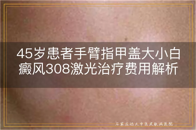 45岁患者手臂指甲盖大小白癜风308激光治疗费用解析
