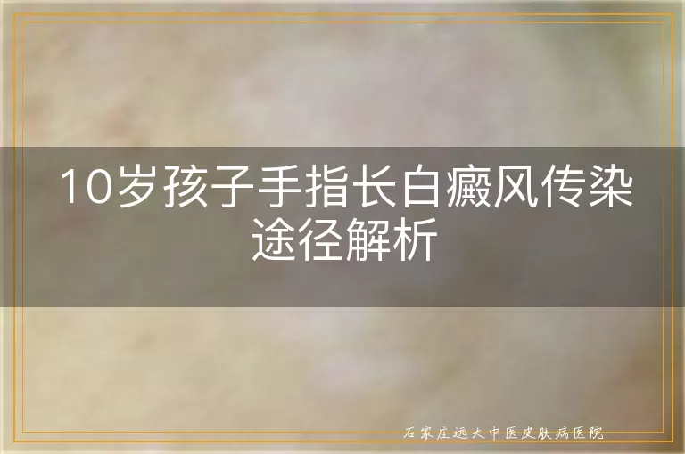10岁孩子手指长白癜风传染途径解析