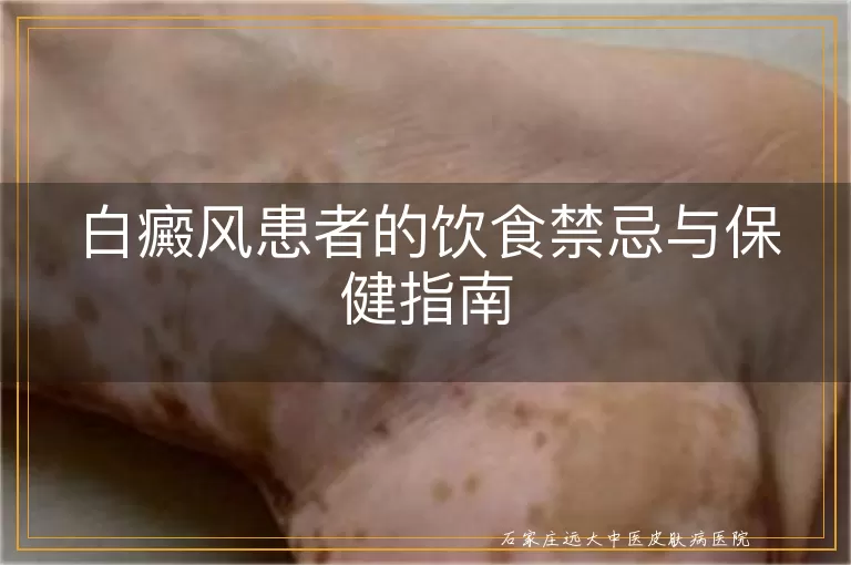 白癜风患者的饮食禁忌与保健指南
