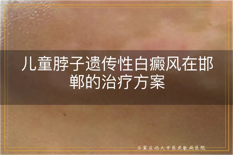 儿童脖子遗传性白癜风在邯郸的治疗方案