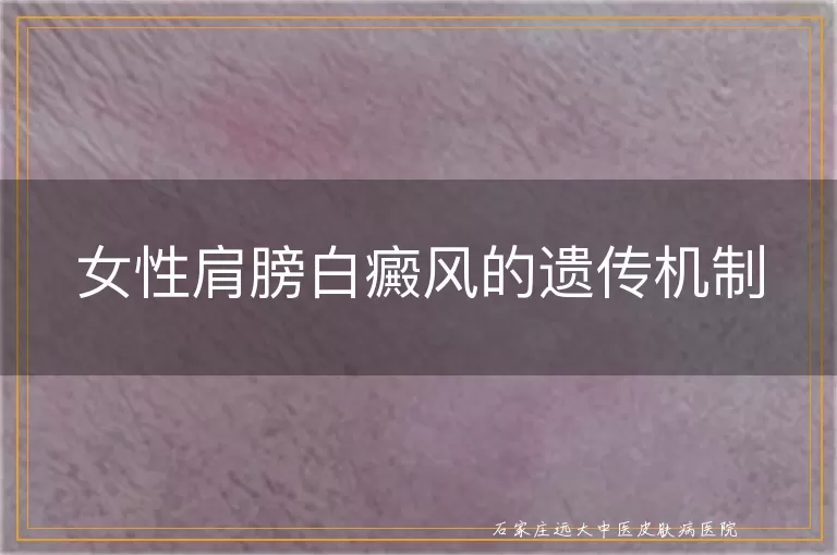女性肩膀白癜风的遗传机制