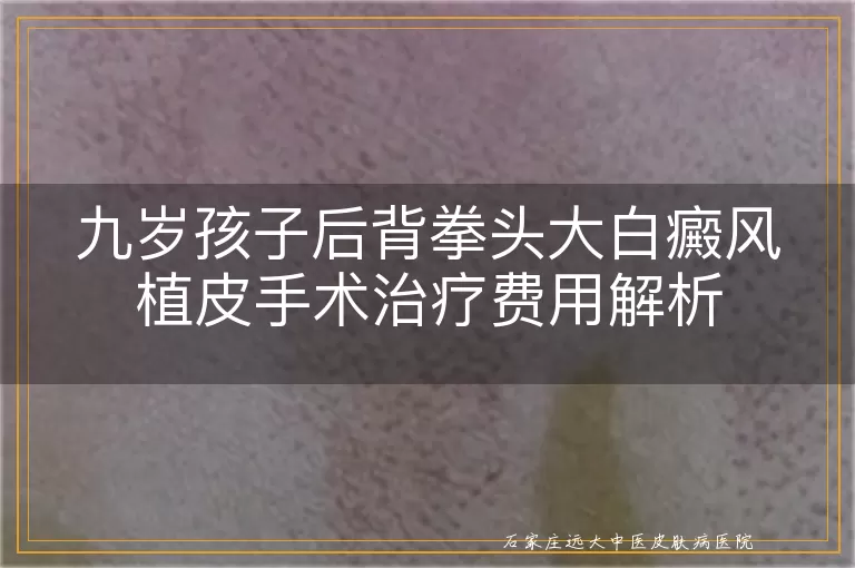 九岁孩子后背拳头大白癜风植皮手术治疗费用解析
