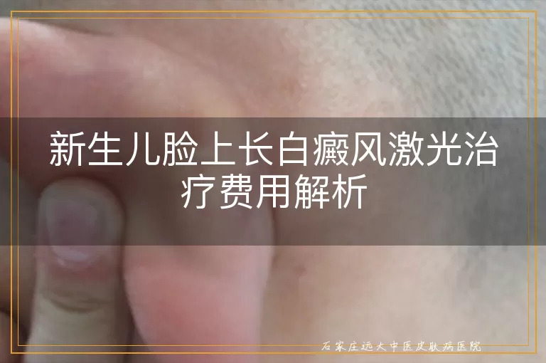 新生儿脸上长白癜风激光治疗费用解析