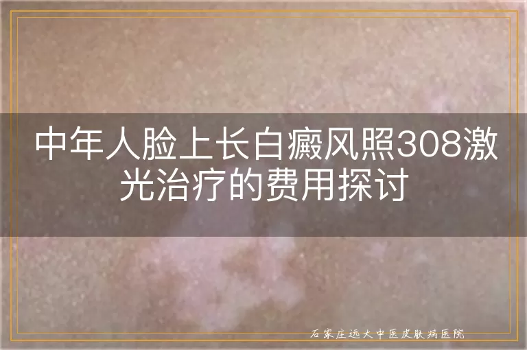 中年人脸上长白癜风照308激光治疗的费用探讨