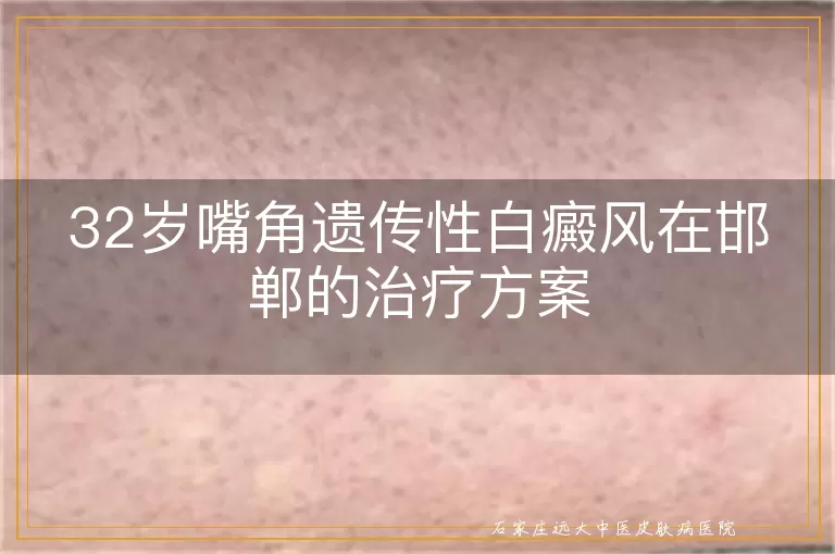 32岁嘴角遗传性白癜风在邯郸的治疗方案