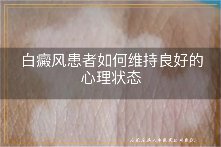 白癜风患者如何维持良好的心理状态