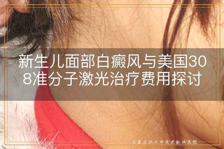 新生儿面部白癜风与美国308准分子激光治疗费用探讨