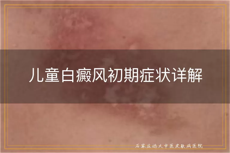 儿童白癜风初期症状详解