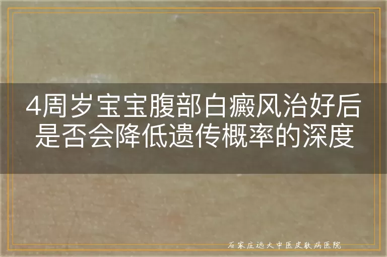 4周岁宝宝腹部白癜风治好后是否会降低遗传概率的深度探讨