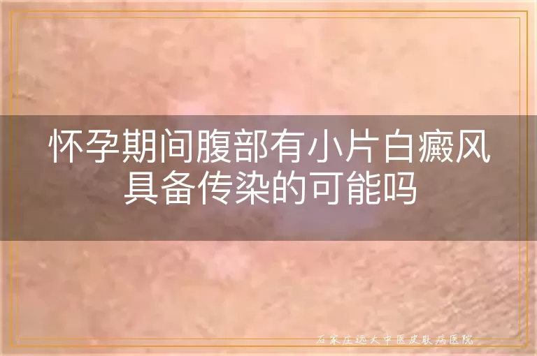 怀孕期间腹部有小片白癜风具备传染的可能吗