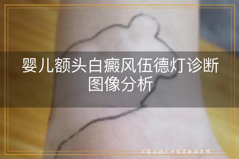 婴儿额头白癜风伍德灯诊断图像分析