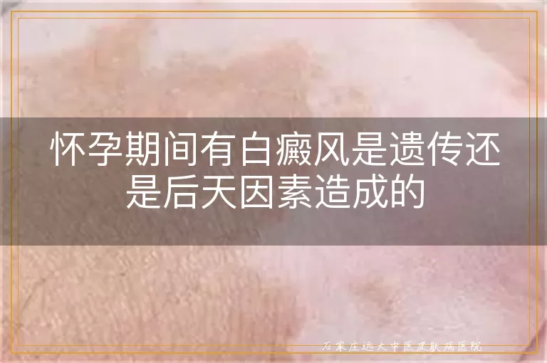 怀孕期间有白癜风是遗传还是后天因素造成的