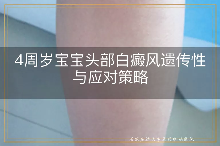 4周岁宝宝头部白癜风遗传性与应对策略