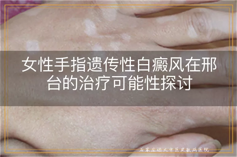 女性手指遗传性白癜风在邢台的治疗可能性探讨