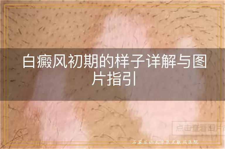 白癜风初期的样子详解与图片指引
