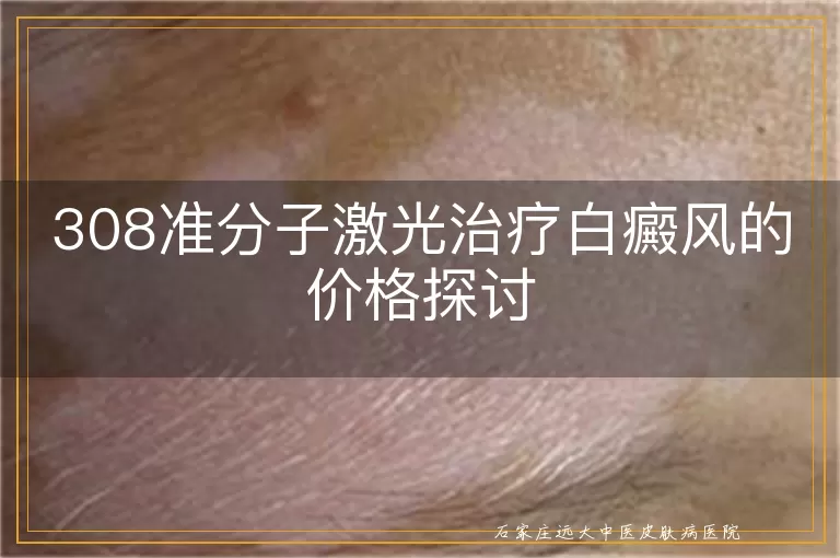308准分子激光治疗白癜风的价格探讨