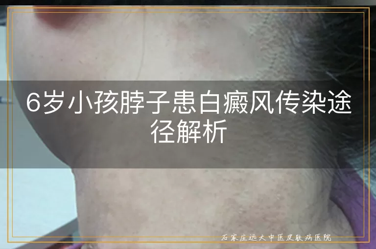 6岁小孩脖子患白癜风传染途径解析