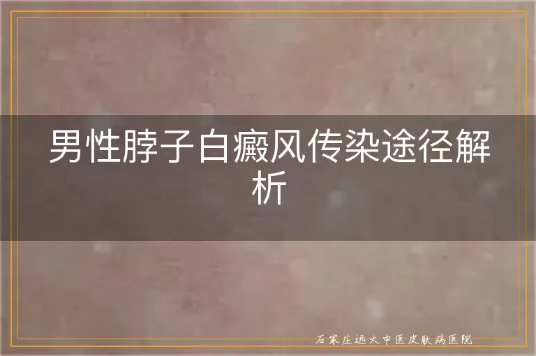 男性脖子白癜风传染途径解析