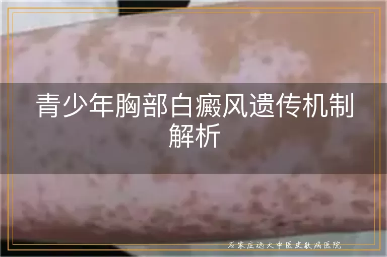 青少年胸部白癜风遗传机制解析