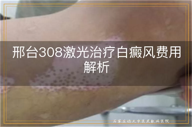 邢台308激光治疗白癜风费用解析