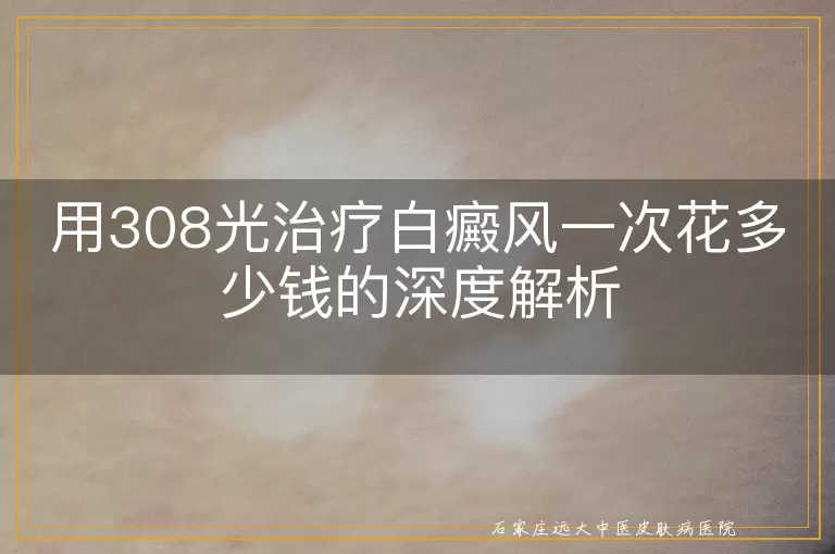 用308光治疗白癜风一次花多少钱的深度解析
