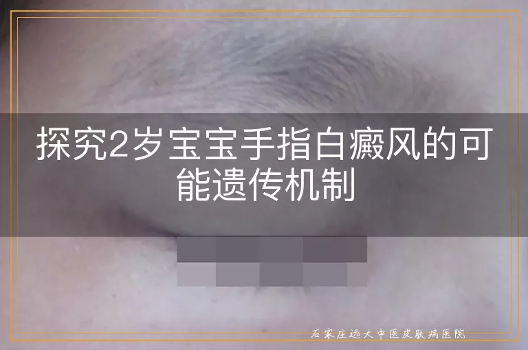 探究2岁宝宝手指白癜风的可能遗传机制