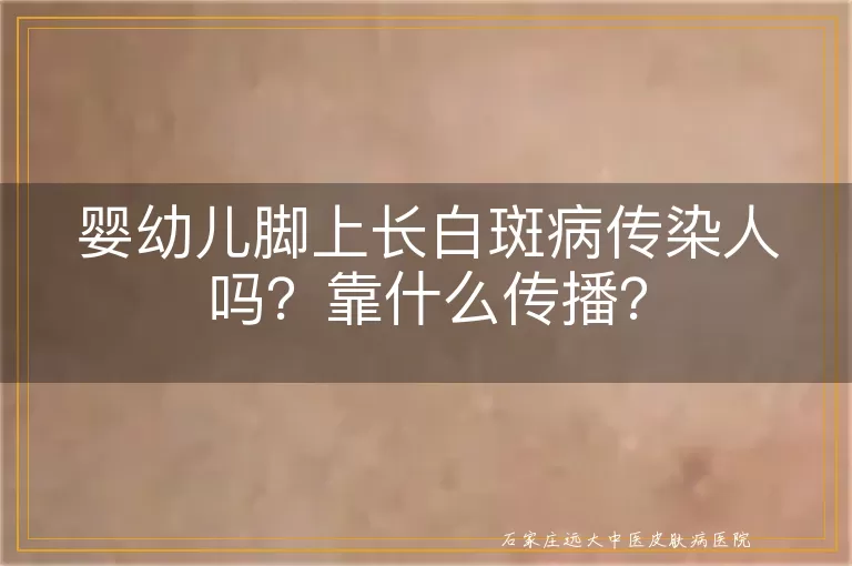 婴幼儿脚上长白斑病传染人吗？靠什么传播？