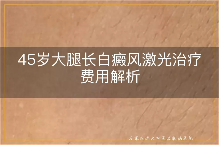 45岁大腿长白癜风激光治疗费用解析
