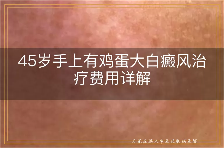 45岁手上有鸡蛋大白癜风治疗费用详解