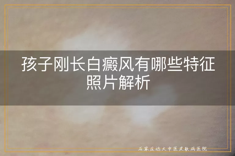 孩子刚长白癜风有哪些特征照片解析