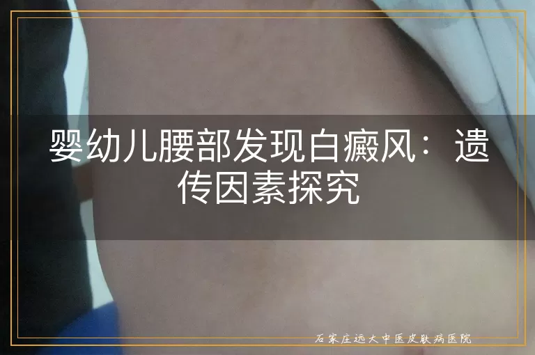 婴幼儿腰部发现白癜风：遗传因素探究
