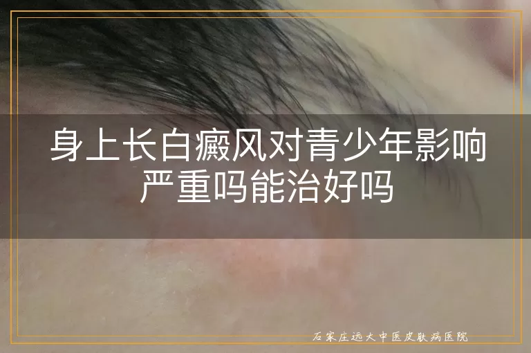 身上长白癜风对青少年影响严重吗能治好吗