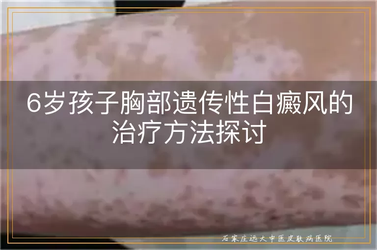 6岁孩子胸部遗传性白癜风的治疗方法探讨