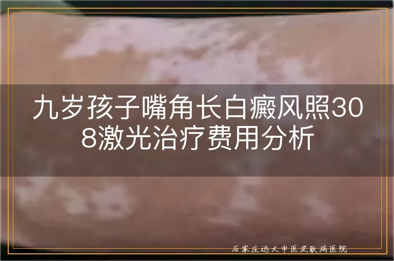 九岁孩子嘴角长白癜风照308激光治疗费用分析