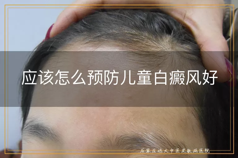 应该怎么预防儿童白癜风好