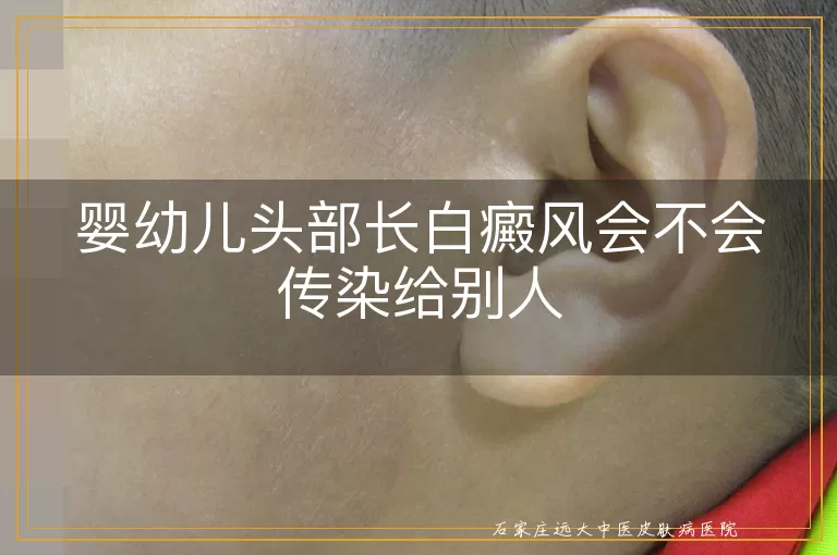 婴幼儿头部长白癜风会不会传染给别人