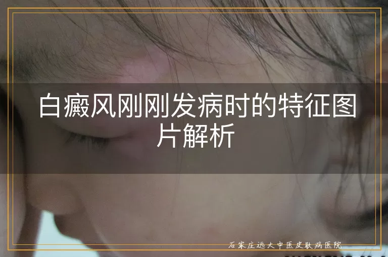 白癜风刚刚发病时的特征图片解析