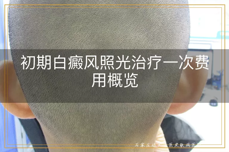 初期白癜风照光治疗一次费用概览