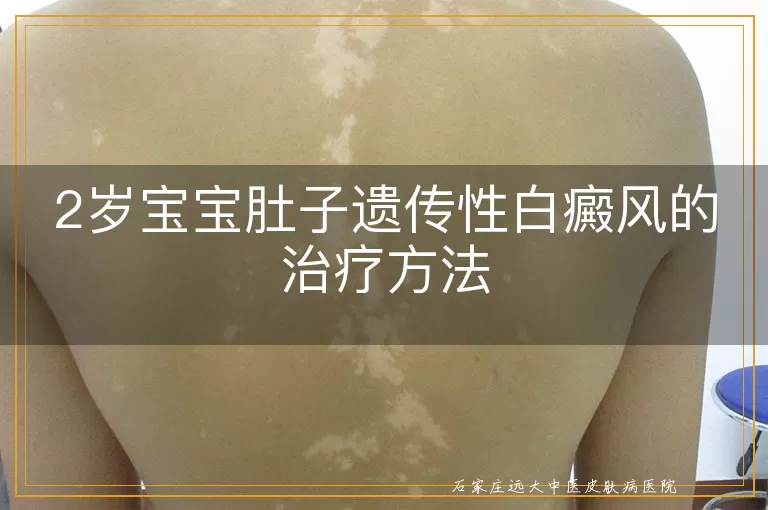 2岁宝宝肚子遗传性白癜风的治疗方法
