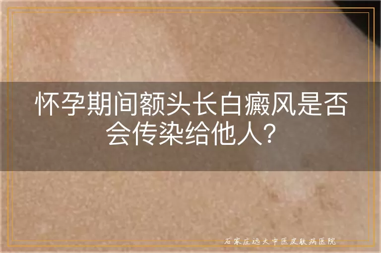 怀孕期间额头长白癜风是否会传染给他人？