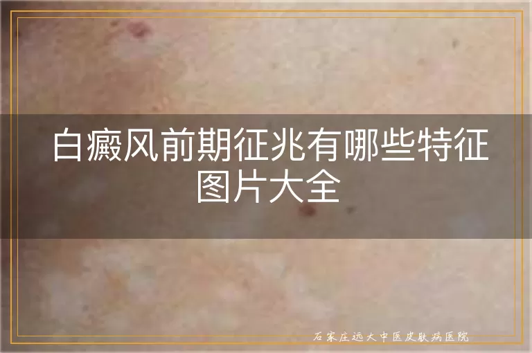 白癜风前期征兆有哪些特征图片大全