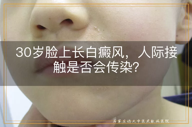 30岁脸上长白癜风，人际接触是否会传染？