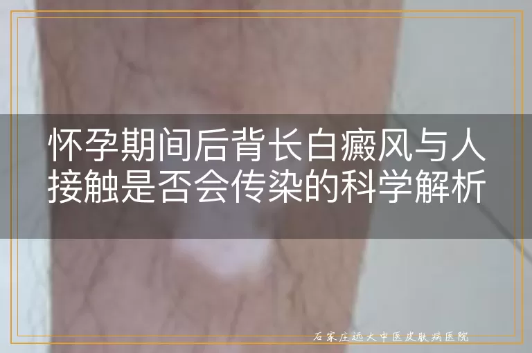 怀孕期间后背长白癜风与人接触是否会传染的科学解析