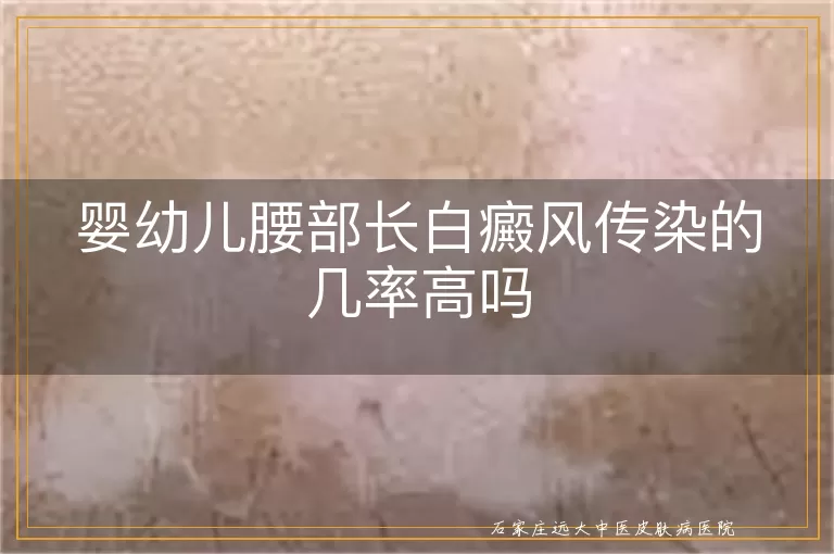 婴幼儿腰部长白癜风传染的几率高吗