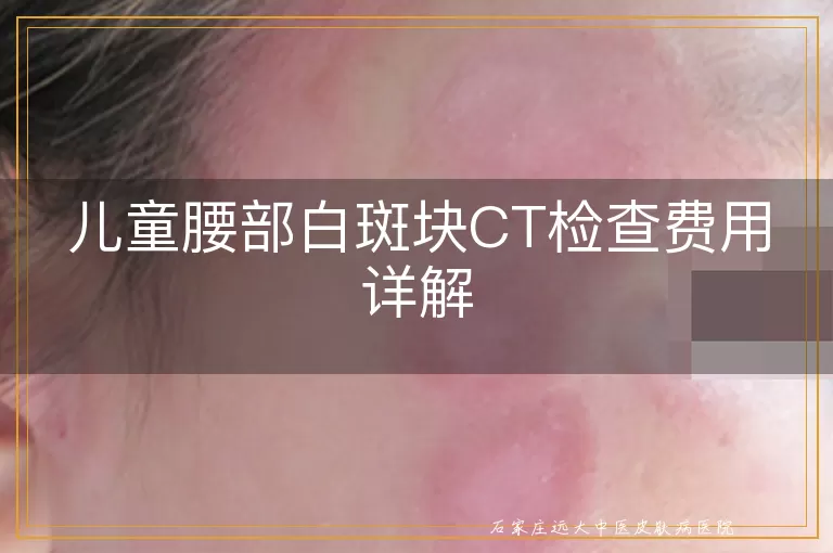 儿童腰部白斑块CT检查费用详解