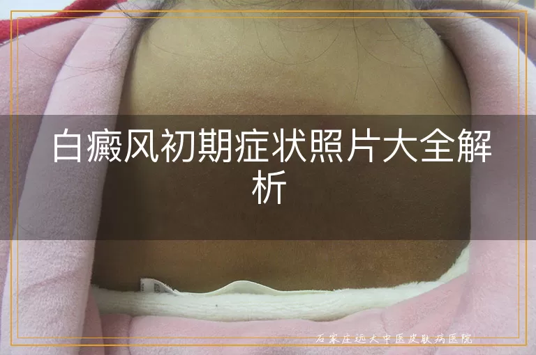 白癜风初期症状照片大全解析